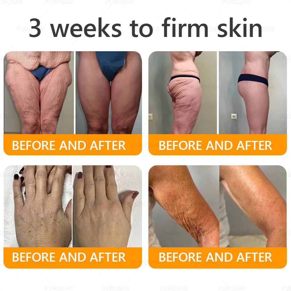 Official U.S. Store🌸PUROSA® Bee Venom Comprehensive Cream🔥LAST DAY: 80% OFF (For sagging skin, fine lines, loss of firmness, flat bust, drooping hips, and more)