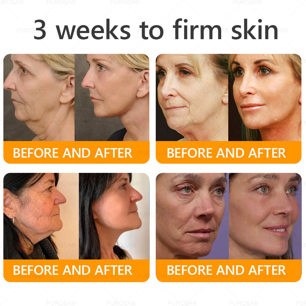 Official U.S. Store🌸PUROSA® Bee Venom Comprehensive Cream🔥LAST DAY: 80% OFF (For sagging skin, fine lines, loss of firmness, flat bust, drooping hips, and more)