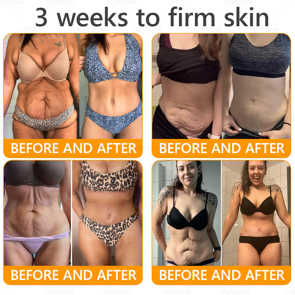 Official U.S. Store🌸PUROSA® Bee Venom Comprehensive Cream🔥LAST DAY: 80% OFF (For sagging skin, fine lines, loss of firmness, flat bust, drooping hips, and more)