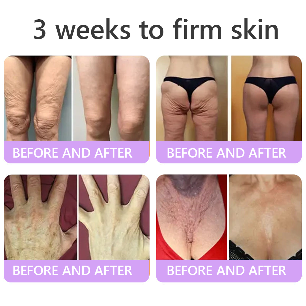 𝑭𝑫𝑨 𝑶𝒇𝒇𝒊𝒄𝒊𝒂𝒍: 𝐇𝐈𝐒𝐊𝐈𝐍® 𝑷𝑫𝑹𝑵 𝑴𝒖𝒍𝒕𝒊-𝑷𝒆𝒑𝒕𝒊𝒅𝒆 𝑴𝒂𝒔𝒔𝒂𝒈𝒊𝒏𝒈 𝑩𝒐𝒅𝒚 𝑹𝒐𝒍𝒍𝒆𝒓 𝗖𝗿𝗲𝗮𝗺- 𝗔𝗻𝘁𝗶-𝗮𝗴𝗶𝗻𝗴, 𝗛𝘆𝗱𝗿𝗮𝘁𝗶𝗻𝗴,𝗦𝗸𝗶𝗻 𝗙𝗶𝗿𝗺𝗶𝗻𝗴 & 𝗟𝗶𝗳𝘁𝗶𝗻𝗴, 𝗦𝗸𝗶𝗻 𝗥𝗲𝗽𝗮𝗶𝗿, 𝗘𝘃𝗲𝗻 𝗧𝗼𝗻𝗲, 𝗔𝗰𝗻𝗲 𝗮𝗻𝗱 𝗗𝗮𝗿𝗸 𝗦𝗽𝗼𝘁 𝗧𝗿𝗲𝗮𝘁𝗺𝗲𝗻𝘁, 𝗪𝗮𝗿𝘁 𝗮𝗻𝗱 𝗠𝗼𝗹𝗲 𝗥𝗲𝗺𝗼𝘃𝗮𝗹, 𝗮𝗻𝗱 𝗣𝘀𝗼𝗿𝗶𝗮𝘀𝗶𝘀 𝗥𝗲𝗹𝗶𝗲𝗳.