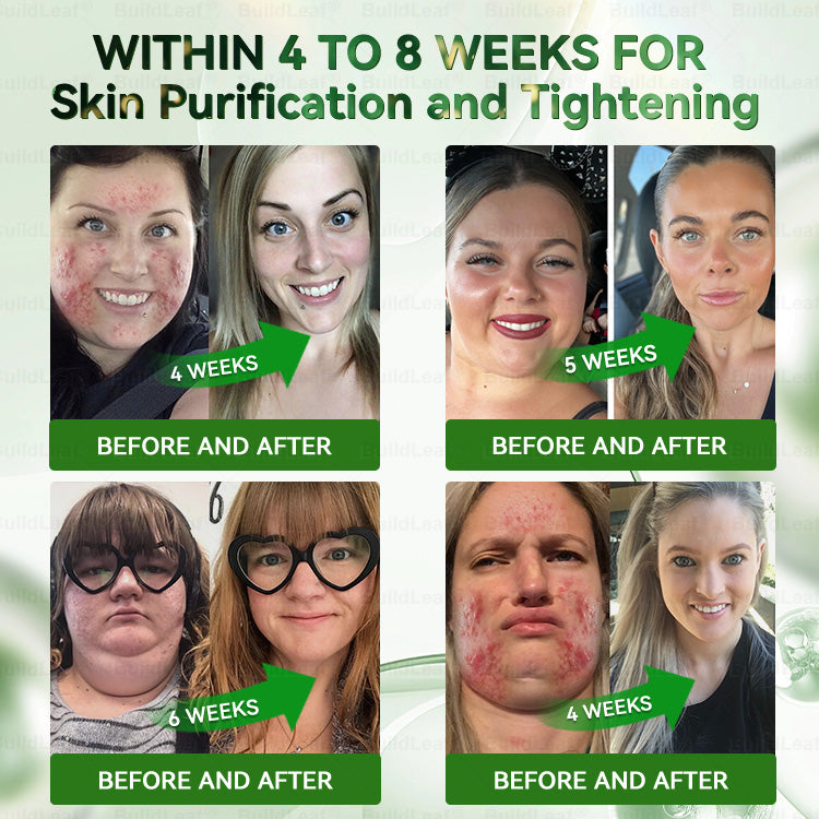 A  𝐵𝑢𝑖𝑙𝑑𝐿𝑒𝑎𝑓® 𝗚𝗟𝗣-𝟭 𝟳 𝗗𝗮𝘆𝘀 𝗚𝘂𝘁 𝗖𝗹𝗲𝗮𝗻𝘀𝗲 & 𝗦𝗹𝗶𝗺 𝗦𝘂𝗽𝗽𝗼𝗿𝘁 𝗢𝗿𝗮𝗹 𝗦𝗼𝗹𝘂𝘁𝗶𝗼𝗻 for Digestive Cleanse ,𝑶𝒃𝒆𝒔𝒊𝒕𝒚, 𝑴𝒆𝒏𝒕𝒂𝒍 𝑪𝒍𝒂𝒓𝒊𝒕𝒚,𝑫𝒊𝒂𝒃𝒆𝒕𝒆𝒔, 𝑫𝒊𝒈𝒆𝒔𝒕𝒊𝒗𝒆 & 𝑪𝒂𝒓𝒅𝒊𝒐𝒗𝒂𝒔𝒄𝒖𝒍𝒂𝒓 𝑯𝒆𝒂𝒍𝒕𝒉, 𝑱𝒐𝒊𝒏𝒕 𝑺𝒖𝒑𝒑𝒐𝒓𝒕, 𝑺𝒌𝒊𝒏 𝑭𝒊𝒓𝒎𝒊𝒏𝒈, 𝑨𝒏𝒕𝒊-𝑨𝒈𝒊𝒏𝒈, 𝑺𝒕𝒓𝒆𝒔𝒔 𝑹𝒆𝒍𝒊𝒆𝒇 & 𝑬𝒏𝒆𝒓𝒈𝒚 𝑩𝒐𝒐𝒔𝒕